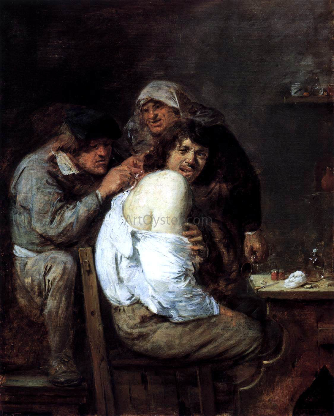  Adriaen Brouwer The Back Operation - Canvas Print